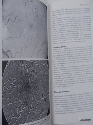 Complications of Diabetes Second Edition