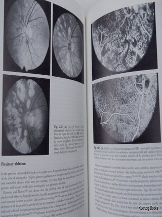 Complications of Diabetes Second Edition