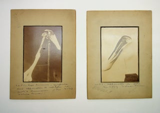 photographs, medical] Four photographs of patient Jules Pedoux [the first shoulder replacement? author not stated.
